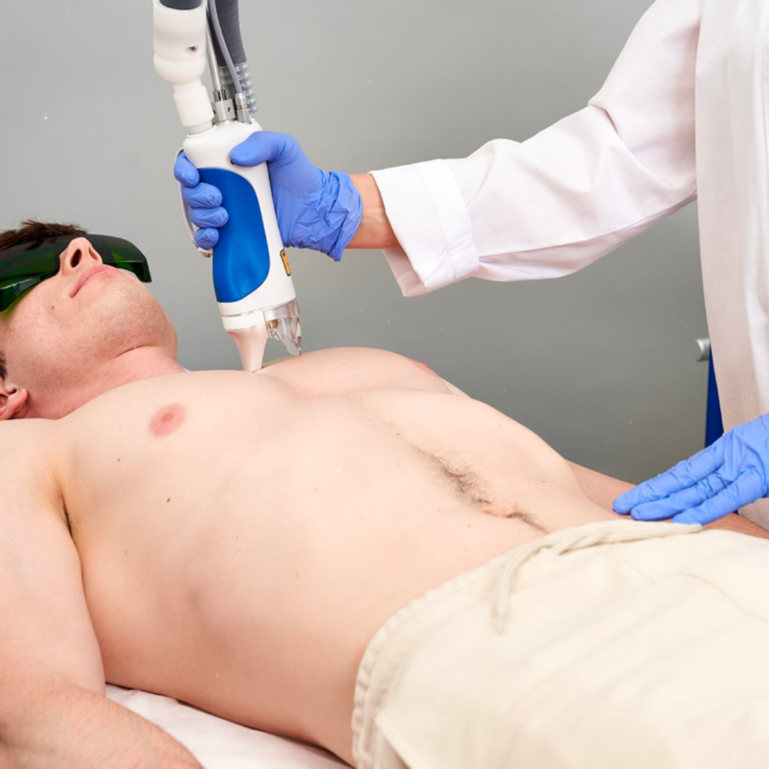 laser hair removal Men